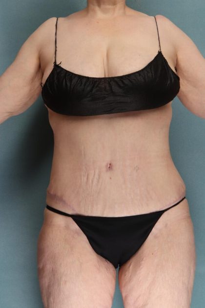 Tummy Tuck Before & After Patient #10403