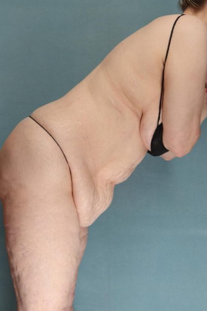 Tummy Tuck Before & After Patient #10403