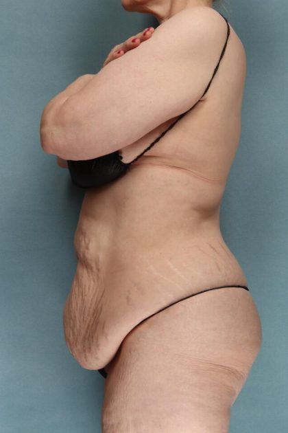 Tummy Tuck Before & After Patient #10403