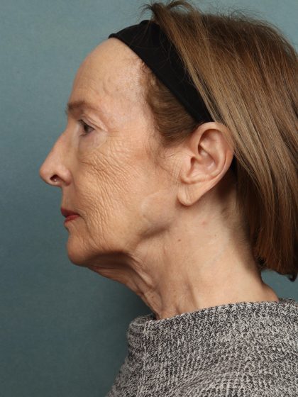 Eye Lift Before & After Patient #10451