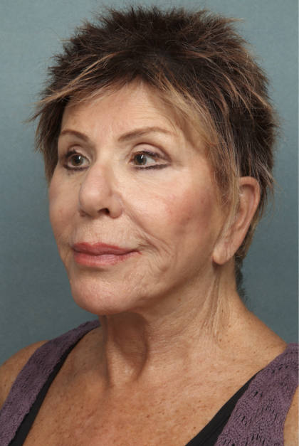 Lip Lift Before & After Patient #10440