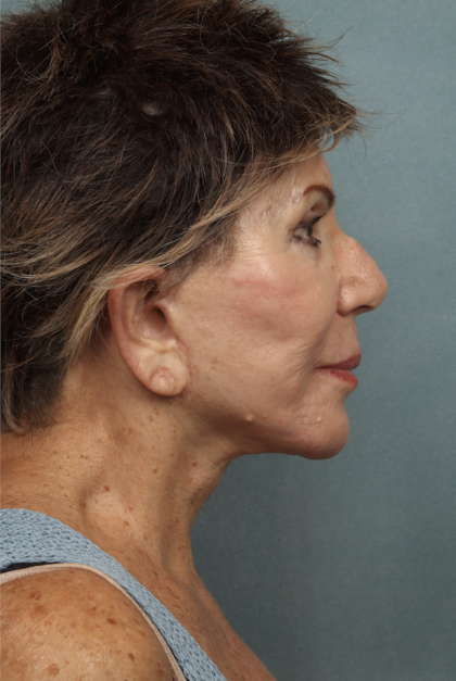 Lip Lift Before & After Patient #10440