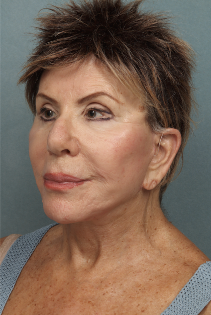 Lip Lift Before & After Patient #10440