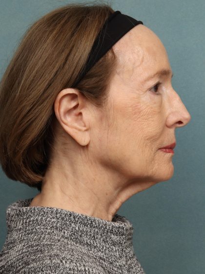 Eye Lift Before & After Patient #10451