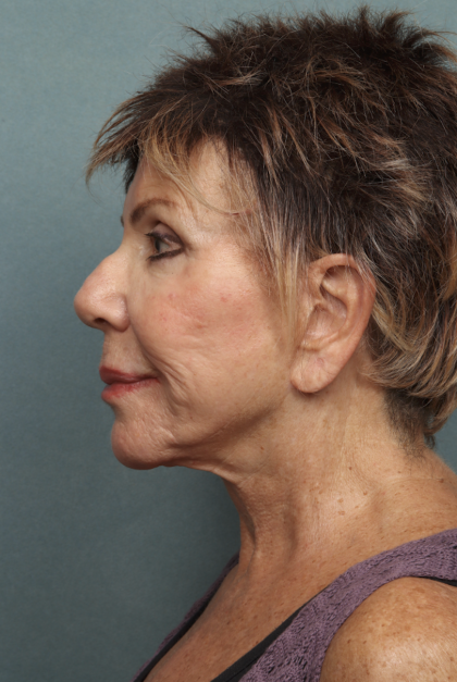 Lip Lift Before & After Patient #10440
