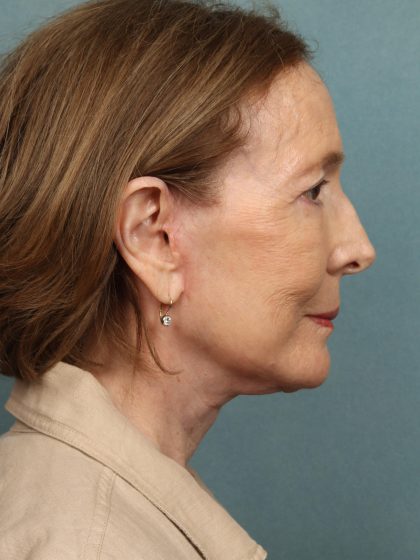 Eye Lift Before & After Patient #10451