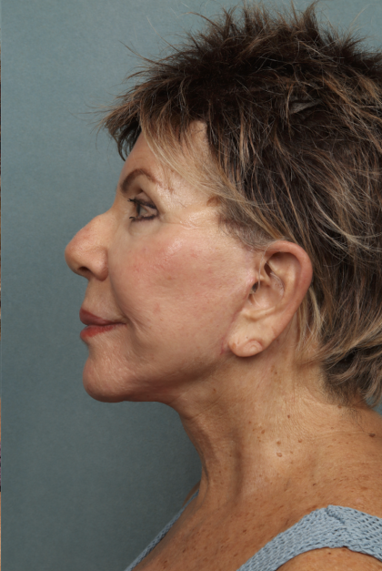 Lip Lift Before & After Patient #10440