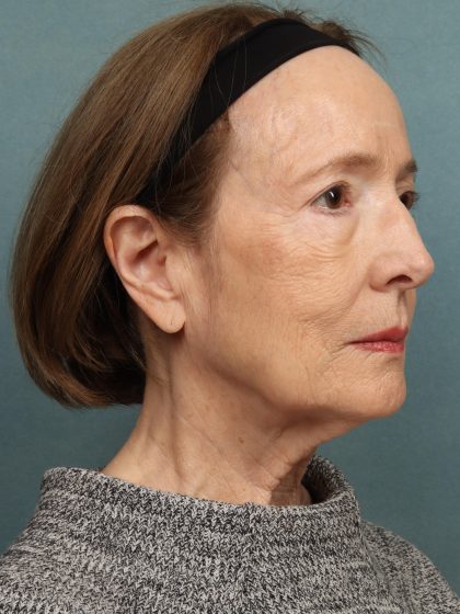 Eye Lift Before & After Patient #10451