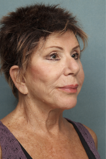 Lip Lift Before & After Patient #10440