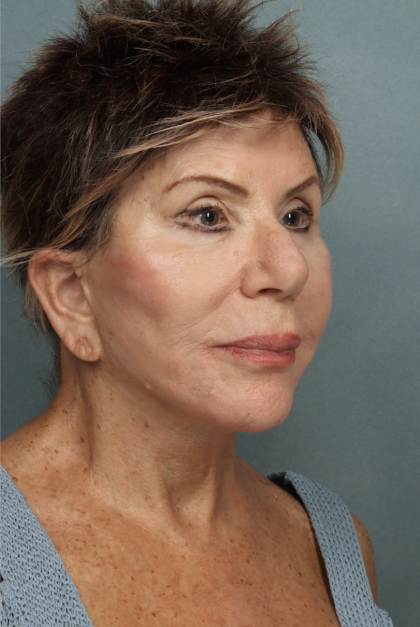 Lip Lift Before & After Patient #10440