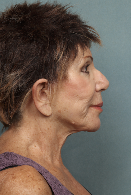 Lip Lift Before & After Patient #10440