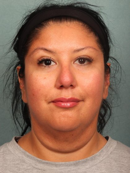 Neck Lift Before & After Patient #10523