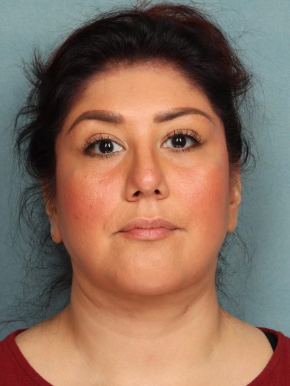 Neck Lift Before & After Patient #10523