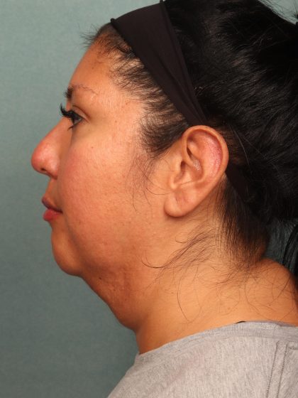 Neck Lift Before & After Patient #10523