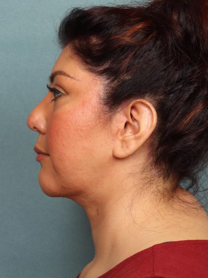 Neck Lift Before & After Patient #10523