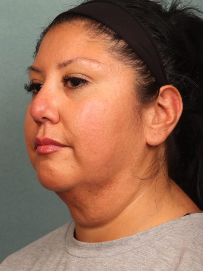 Neck Lift Before & After Patient #10523