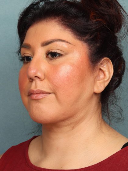Neck Lift Before & After Patient #10523