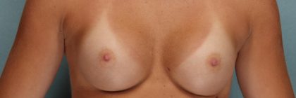 Breast Augmentation Before & After Patient #10468