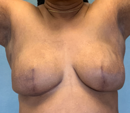 Breast Reconstruction Before & After Patient #10475