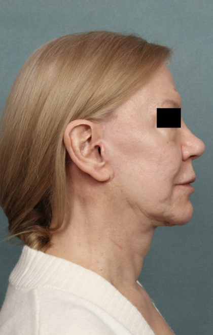 Facelift Before & After Patient #10562