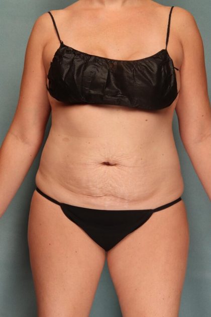 Breast Reconstruction Before & After Patient #10534