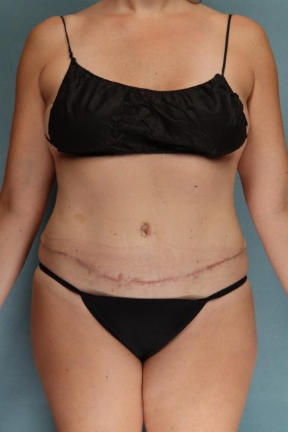 Breast Reconstruction Before & After Patient #10534