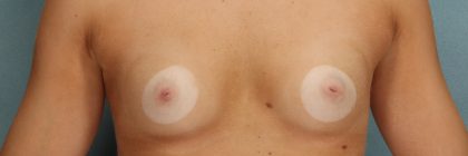 Breast Augmentation Before & After Patient #10468