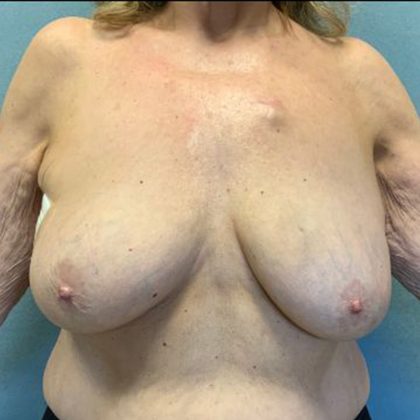 Breast Augmentation Before & After Patient #10504