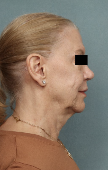 Facelift Before & After Patient #10562