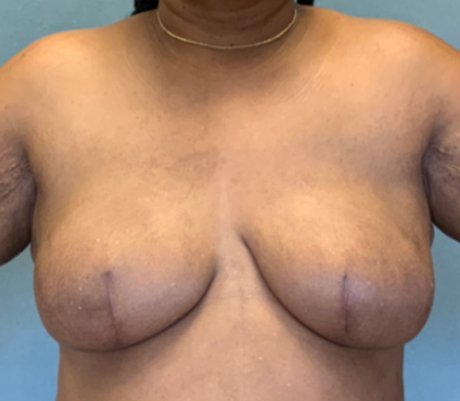 Breast Reconstruction Before & After Patient #10475