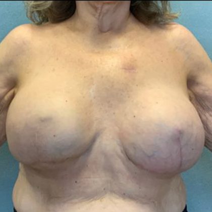 Breast Augmentation Before & After Patient #10504