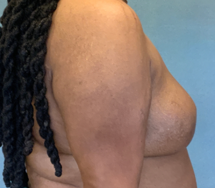 Breast Reconstruction Before & After Patient #10475