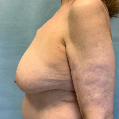 Breast Reconstruction Before & After Patient #10509