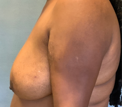 Breast Reconstruction Before & After Patient #10475