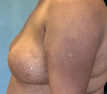 Breast Reconstruction Before & After Patient #10475