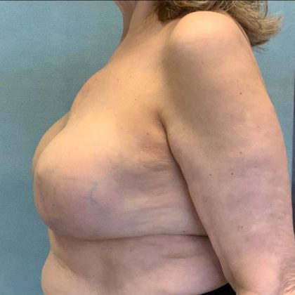 Breast Reconstruction Before & After Patient #10509