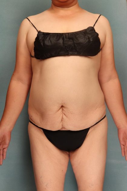 Tummy Tuck Before & After Patient #10543