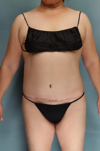 Tummy Tuck Before & After Patient #10543