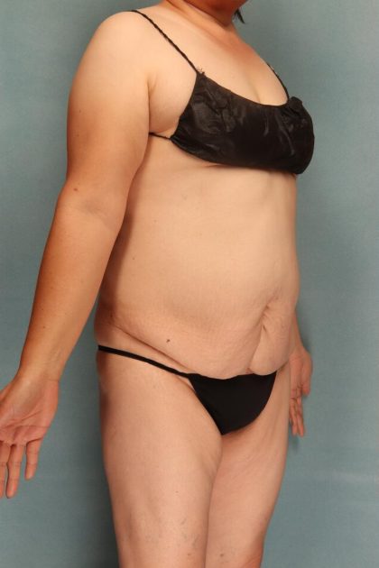 Tummy Tuck Before & After Patient #10543