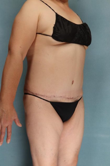 Tummy Tuck Before & After Patient #10543