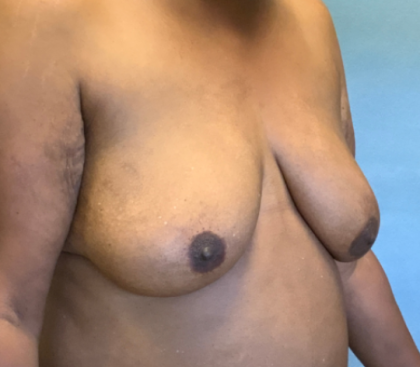 Breast Reconstruction Before & After Patient #10475