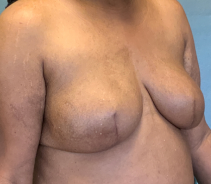 Breast Reconstruction Before & After Patient #10475