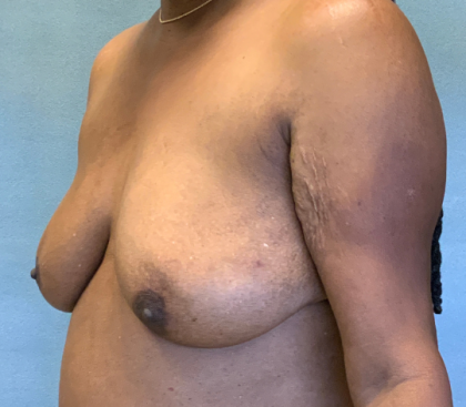 Breast Reconstruction Before & After Patient #10475