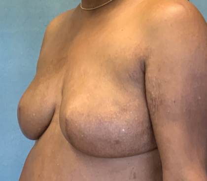 Breast Reconstruction Before & After Patient #10475