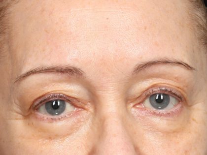 TCA Peel Before & After Patient #10552