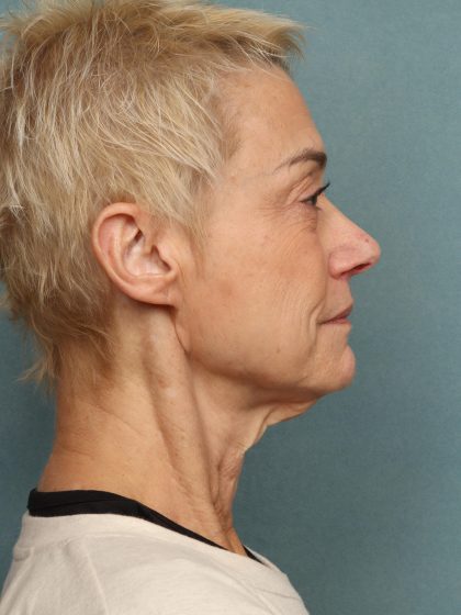 Fat Grafting Before & After Patient #10574