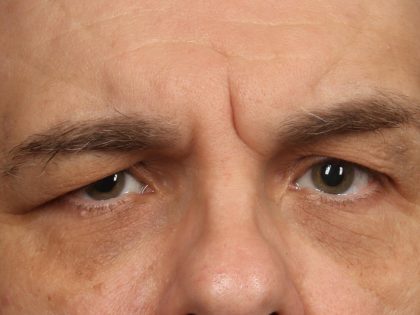 Blepharoplasty Before & After Patient #10510
