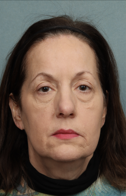 Blepharoplasty Before & After Patient #10514