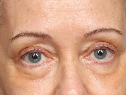 TCA Peel Before & After Patient #10552