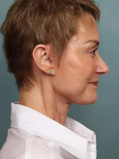 Fat Grafting Before & After Patient #10574